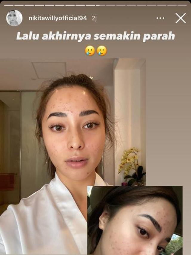 Unggah Foto Berjerawat, Ini 6 Potret Nikita Willy Tampil Natural