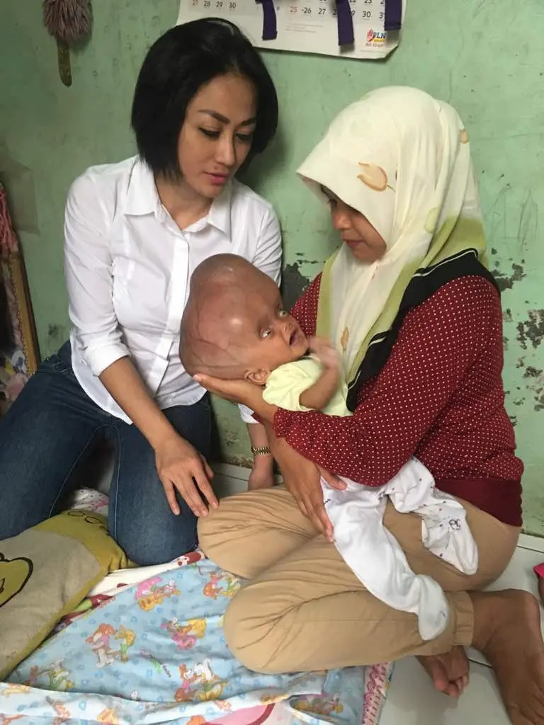 Sisca Dewi salah seorang yang tergerak memberikan bantuan untuk Zhafirah Putri Kirania Main. (Edy Suherli/Bintang.com)