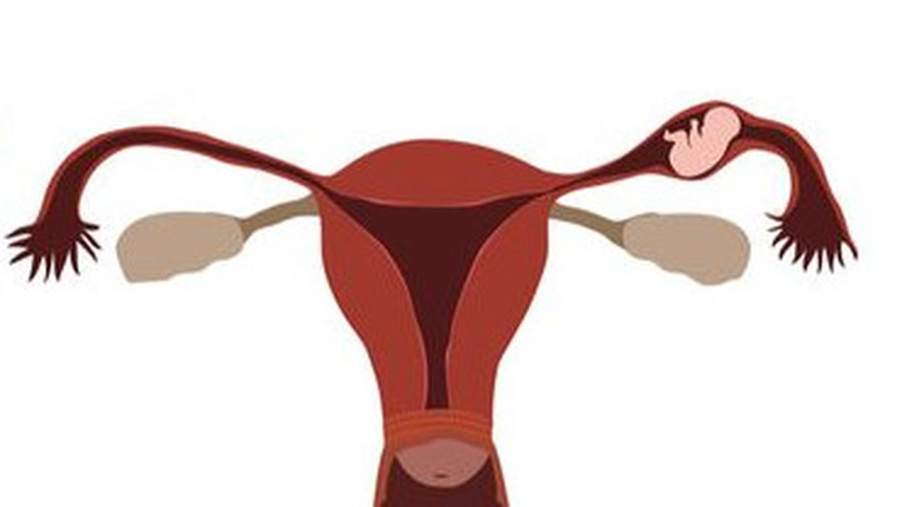 ilustrasi kehamilan ektopik