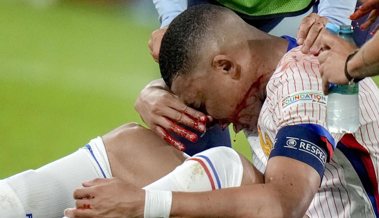 Benturan tersebut membuat pemain anyar Real Madrid ini terjatuh dan hidungnya mengeluarkan banyak darah. (AP Photo/Alessandra Tarantino)