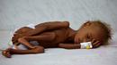 Seorang anak tergeletak di tempat tidur di unit malnutrisi perawatan intensif di sebuah rumah sakit di kota pelabuhan Laut Merah dari Hodaida, Yaman pada 11 September 2016. (REUTERS/Khaled Abdullah)