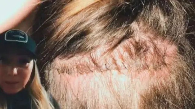 Transplantasi Rambut Bikin Alis Wanita Ini Tumbuh Panjang Sampai Harus Sering Dipotong
