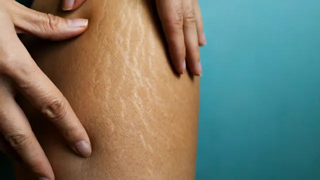 Stretch Mark