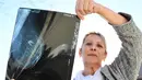 Sylvie Anane (54) menunjukkan mammogram miliknya yang terdapat tumor di rumahnya di Fos-sur-Mer, Prancis (10/10). Sylvie Anane mengalami penyakit arteri koroner pertamanya pada usia 38 tahun. (AFP Photo/Boris Horvat)