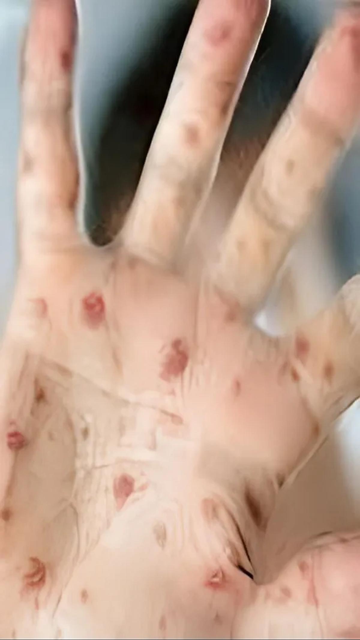 Adapun seluruh pasien merupakan laki-laki berusia 25-50 tahun. Mereka tertular dari kontak seksual.<br>