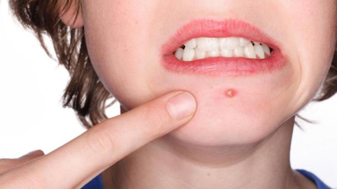 Cara Mudah Tutupi Jerawat, Aw Mau Dong!