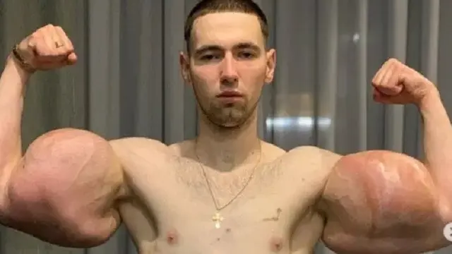 Kirill nyaris meninggal karena otot palsu yang dia miliki (Tangkapan Layar Metro/Alana Mamaeva)