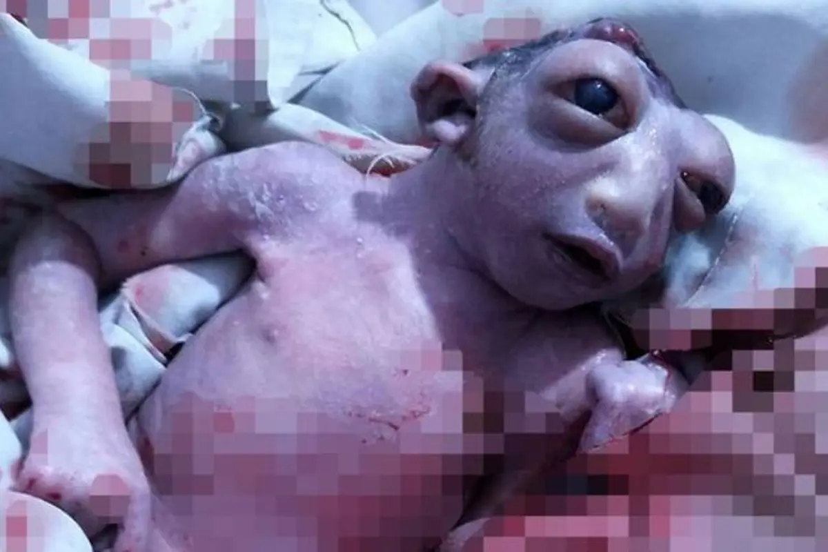 Mengenaskan, Bayi Lahir dengan Separuh Kepala dan Mata Menonjol