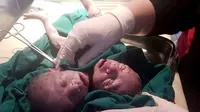 Tragis, Nasib Bayi yang Lahir dengan 2 Kepala dalam 1 Tubuh
