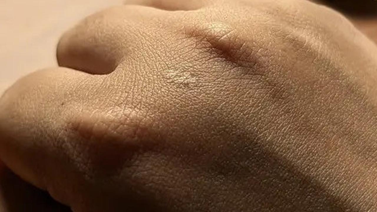 6 Cara Ampuh Menghilangkan Keloid yang Membandel dan Mengembalikan Percaya Diri Anda