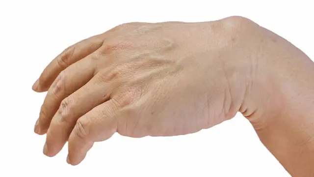 Kista Ganglion