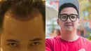 YouTuber Edho Zell menjalani transplantasi rambut tahun 2020. Kini, terlihat bagian depan rambutnya yang semakin tumbuh lebat (Instagram&YouTube/edhozell).