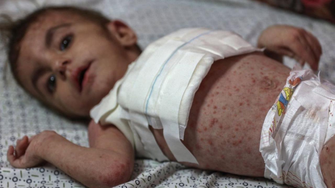 Bayi perempuan Wateen al-Adasi mendapatkan perawatan di sebuah rumah sakit di Beit Lahia, Jalur Gaza, Palestina, pada 2 Juli 2024.&nbsp;Wateen al-Adasi, yang dirawat karena gizi buruk, juga menderita penyakit kulit. Bintik-bintik merah tersebar hampir di 
