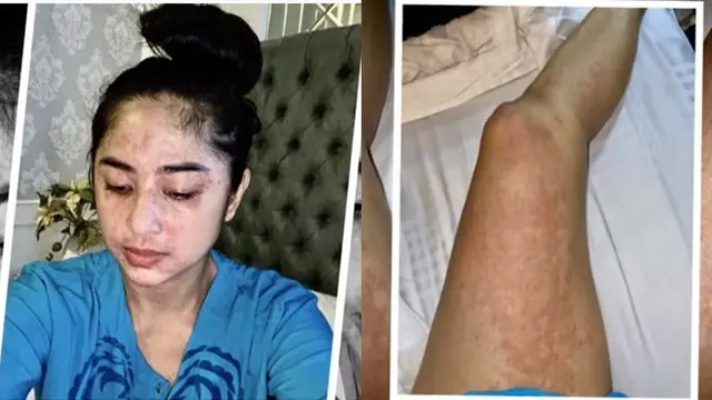 7 Potret Dewi Perssik saat Alami Gejala Corona Covid-19, Penuh Ruam Merah