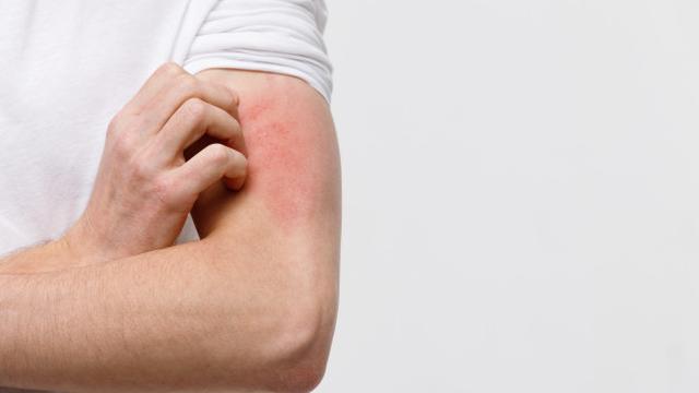 Ilustrasi penyakit kurap