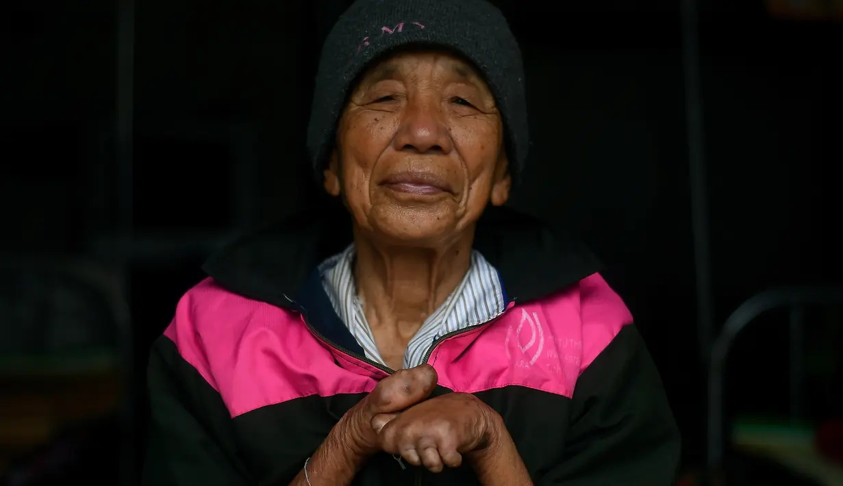 Penderita kusta Nguyen Van Phuc menunjukkan tangannya di kompleks RS Van Mon Leprosy, Thai Binh, Vietnam, Kamis (10/1). Penderita kusta di Vietnam terus menurun berkat peningkatan kesehatan, kebersihan, dan kesadaran. (Manan Vatsyayana/AFP)