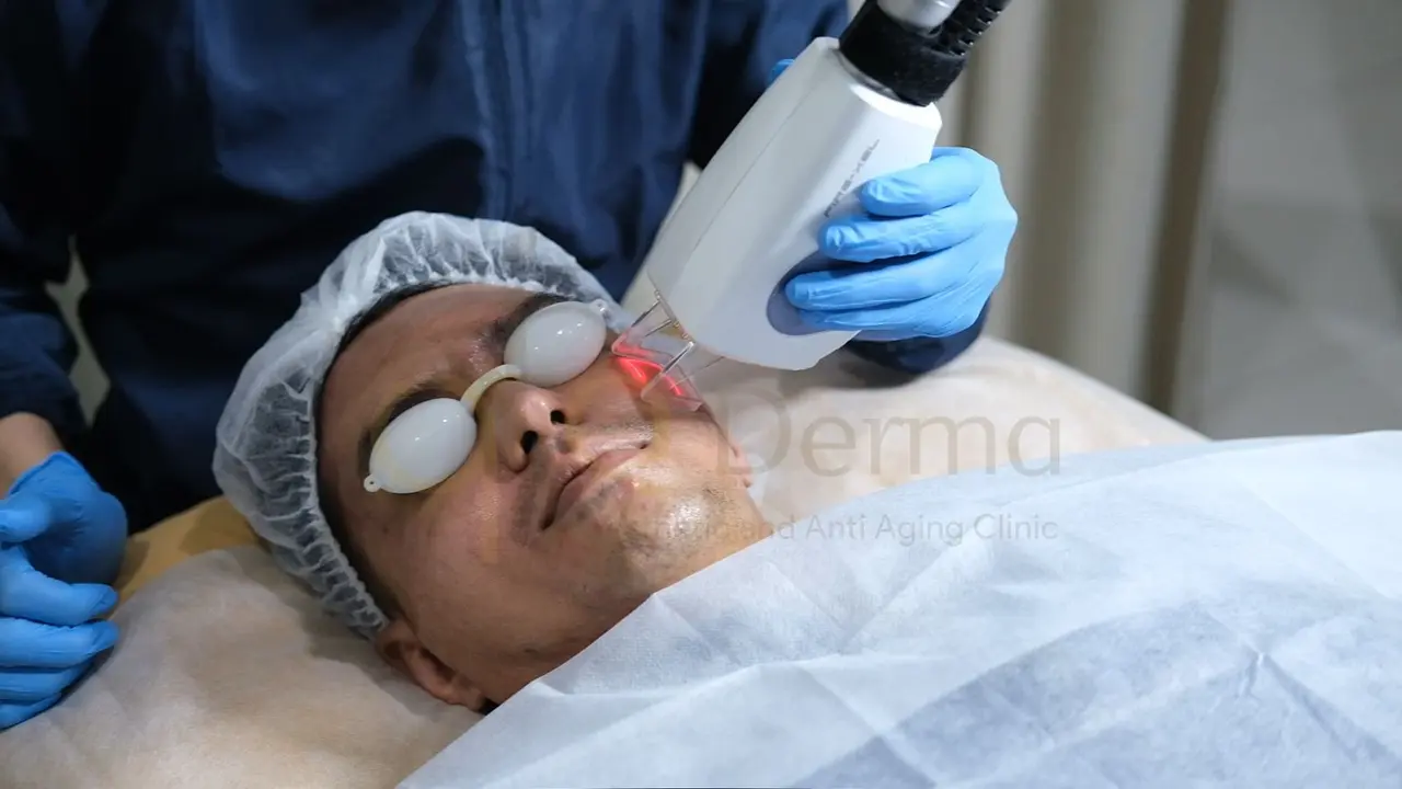 Penggunaan Laser CO2 Fractional