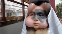 Jalani Terapi Kanker Kulit, Wajah Gadis Ini Malah Mirip Alien