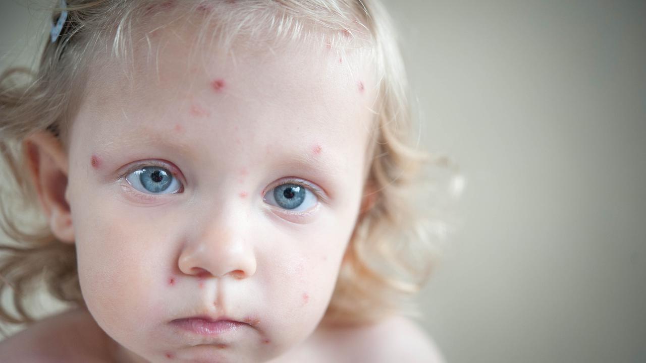 Cacar air (iStockphoto)