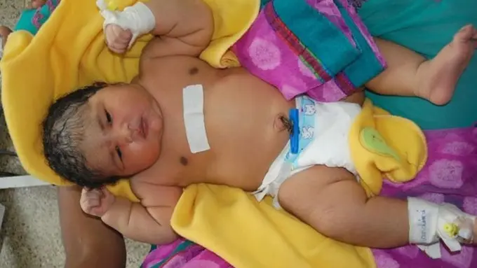Lahirkan Bayi Seberat 6,7 Kg, Wanita India Ini Butuhkan 15 Menit