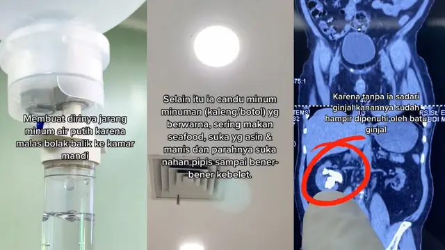 Viral Tenaga Kesehatan Temukan Batu Ginjal yang Berbentuk Seperti Jahe