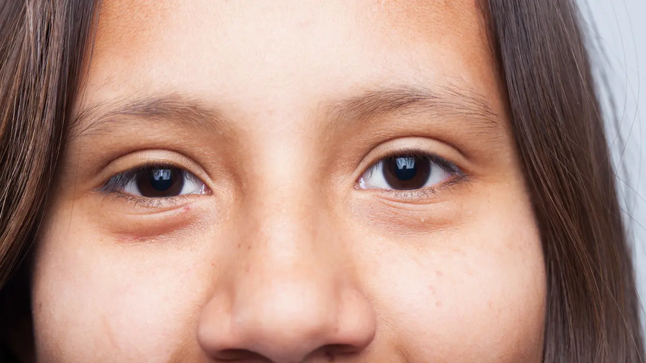 Ptosis