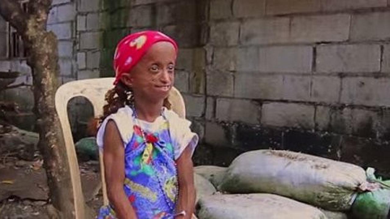 Remaja Filipina wajah dan tubuhnya seperti nenek usia satu abad