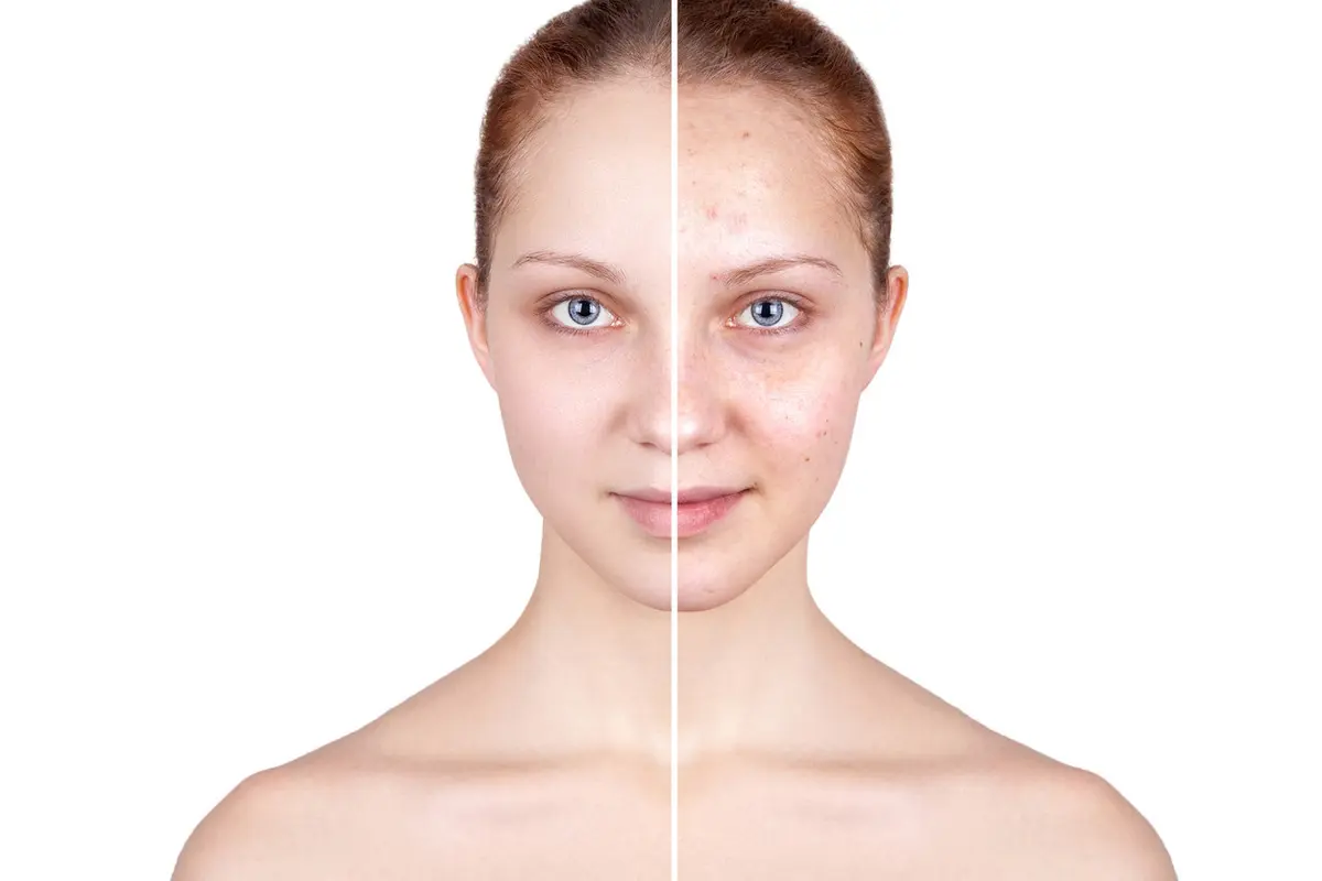 Cara Menghilangkan Jerawat dengan Photoshop