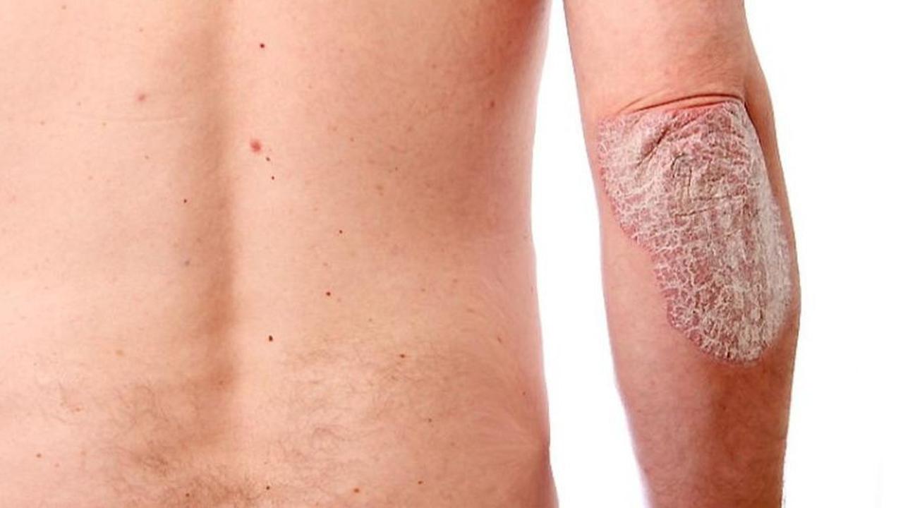 Gejala Psoriasis Vulgaris