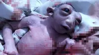 Bayi Perempuan Lahir dengan Separuh Kepala dan Mata Menonjol