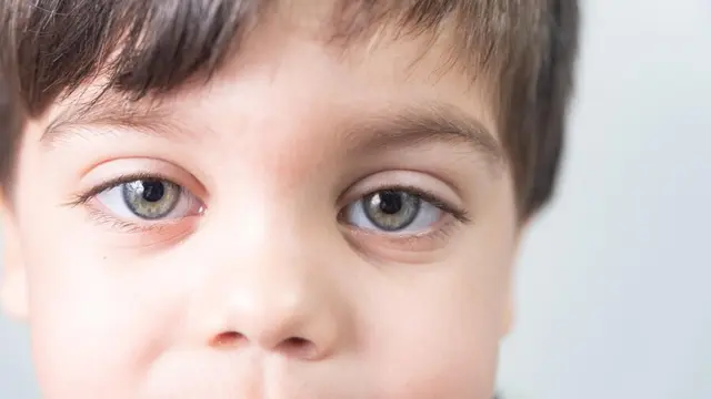 Ilustrasi gangguan mata malas/freepik.com/Mateus Andre