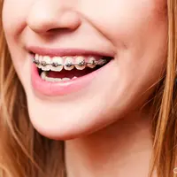 Jika kamu memiliki gigi yang berkawat, kamu pasti paham dengan perjuangan berikut ini.