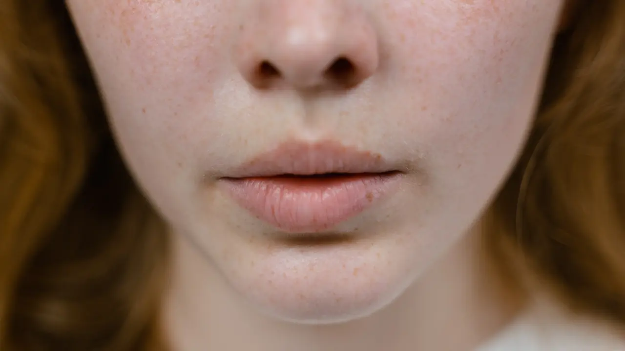 Ilustrasi Melasma