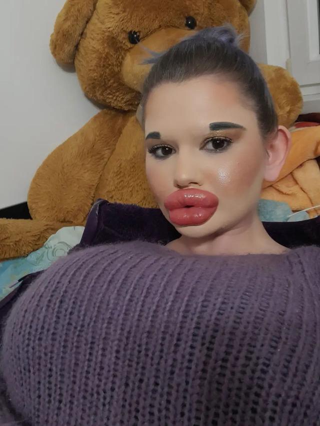 Ingin Tampil Bak Boneka, Wanita Akan Injeksi Bibir Ke 27 Kali Akhir Tahun Ini