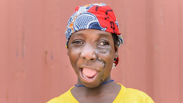 Transformasi Drastis Gadis dengan Tumor Wajah Setelah Dioperasi