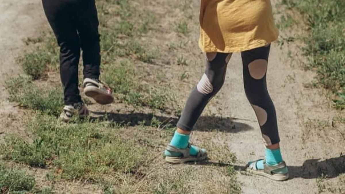 Guided Growth Surgery: Cara Alami Meluruskan Kaki O dan X pada Anak