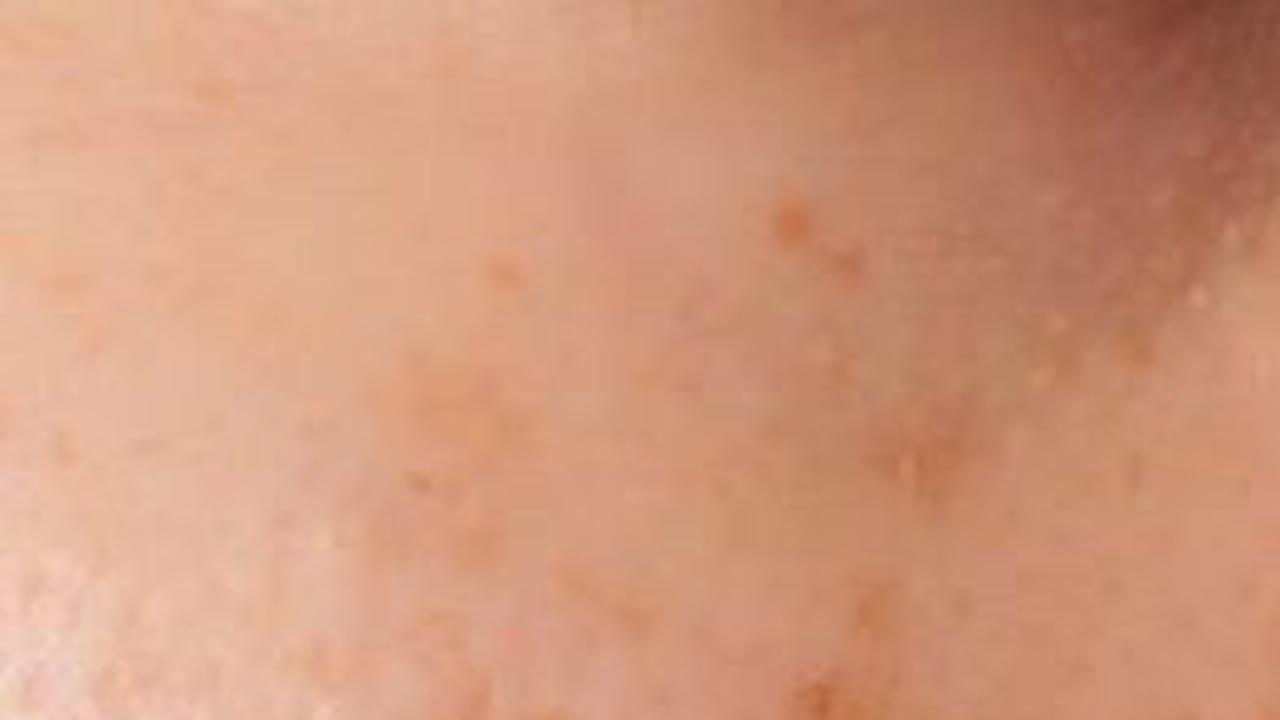 <b>3. Melasma</b><br>