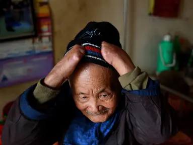 Penderita kusta Nguyen Quang Chieu duduk di ranjang kompleks RS Van Mon Leprosy, Thai Binh, Vietnam, Minggu (20/1). RS Van Mon Leprosy merupakan rumah sakit khusus kusta tertua di Vietnam. (Manan Vatsyayana/AFP)