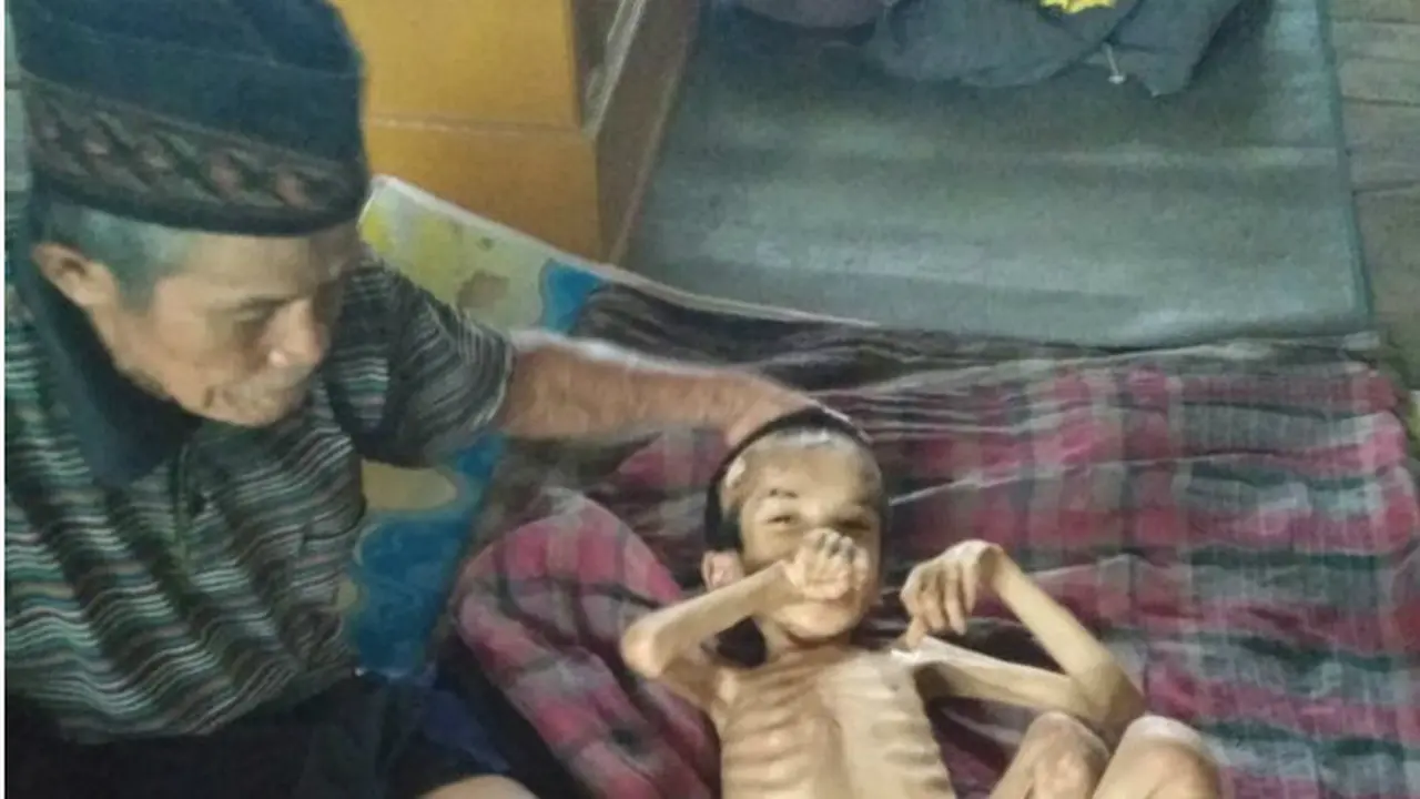 Remaja Penderita Gizi Buruk di Bulukumba