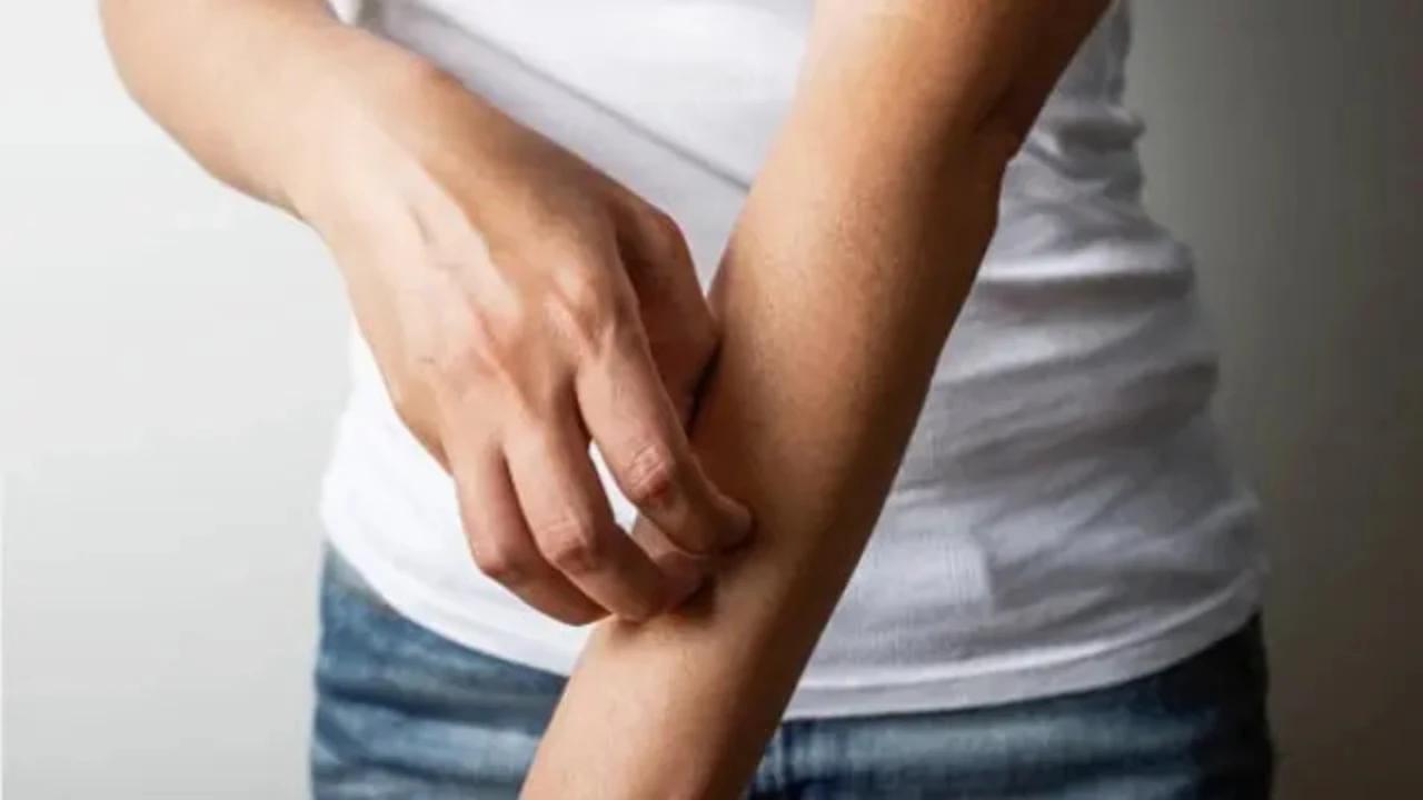 Cara Ampuh Menghilangkan Gatal Akibat Bulu Ulat Tanpa Obat, Bisa Dicoba