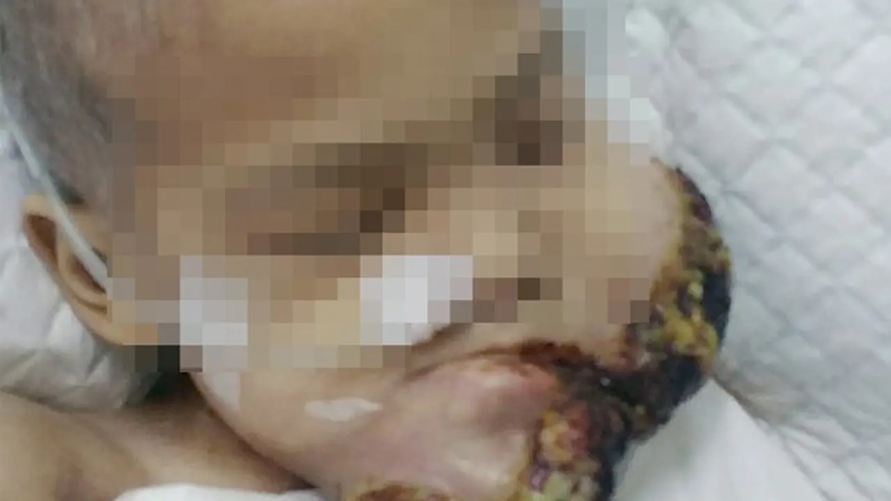 Tragis, Idap Kanker Rahang Bocah Usia 7 Tahun Berantakan