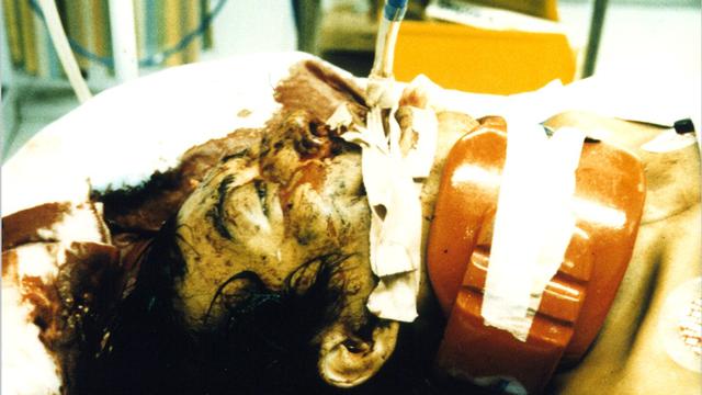 Alami Kecelakaan Tragis, Begini Perjuangan Hidup Pria dengan Otaknya yang Setengah