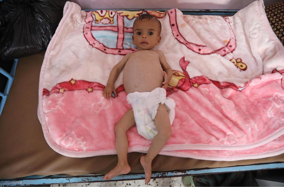 FOTO: Tubuh Kecil yang Lapar, Potret Pedih Bayi Gaza di Tengah Ancaman Kelaparan Massal