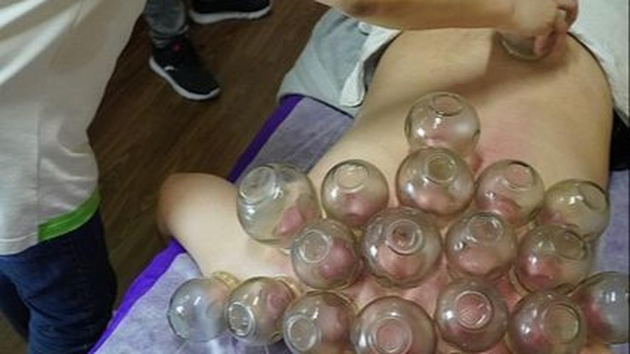Prosedur Terapi Bekam