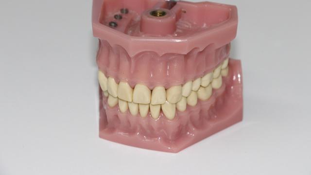 Gingivitis Adalah Kondisi yang Dikenal dengan Sebutan Radang Gusi. Cari Tahu di Sini Apa Saja Gejala Gingivitis atau Radang Gusi, Termasuk Pengobatan yang Tepat untuk Penyakit Gusi Ini (Foto Reto Gerber/Pixabay)