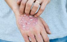 Inovasi Klinik Kecantikan Hadirkan Treatment Psoriasis untuk Keluarga, Cek Fakta Penyakit Ini Yuk!