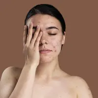 Salah satu masalah kulit yang sering dialami oleh banyak perempuan adalah jerawat, green tea dapat membantu hal tersebut. [Dok/freepik.com]