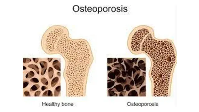Kenali Lebih Dini Osteoporosis dan Osteoarthritis