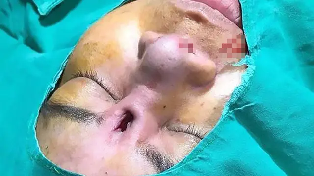 Bedah Hidung Agar Mancung, Wanita Ini Malah Alami Hal Mengerikan