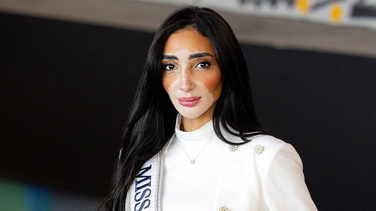 Intip Profil Menarik Logina Salah, Peserta Miss Universe Pertama yang Mengidap Vitiligo